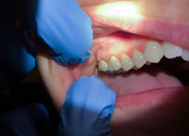Best Emergency Dental Care for Broken or Chipped Teeth in Cullman, AL