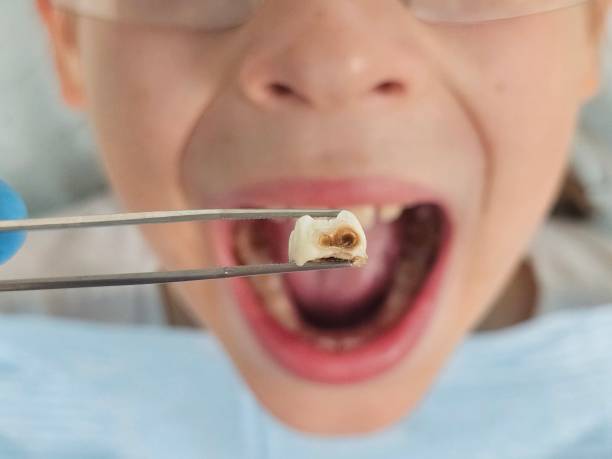 Best Emergency Tooth Extraction in Cullman, AL