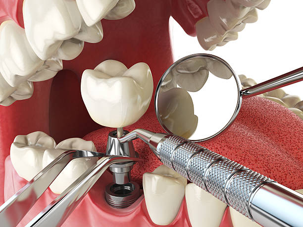 Best Urgent Care for Lost Fillings or Crowns in Cullman, AL